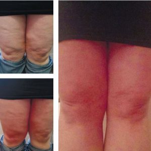 ByeByeCellulite - Erfahrung mit Dr. Juchheim