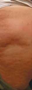 Cellulite Creme nach der ersten Anwendung