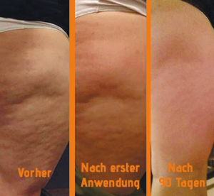 Zusammenstelllung Vorher und Nachher nach Anwendung mit Cellulite Creme